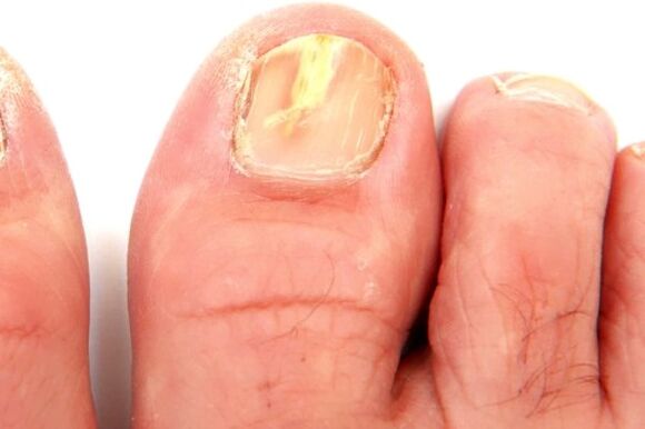 onddoen infekzio baten ondorioz iltze-plakan kalteak